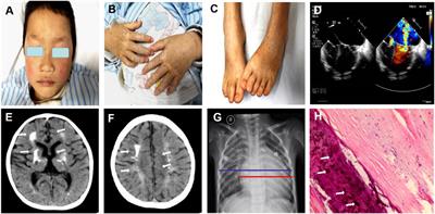 Case Report: Aicardi-Goutières Syndrome Type 6 and Dyschromatosis Symmetrica Hereditaria With Congenital Heart Disease and Mitral Valve Calcification – Phenotypic Variants Caused by Adenosine Deaminase Acting on the RNA 1 Gene Homozygous Mutations